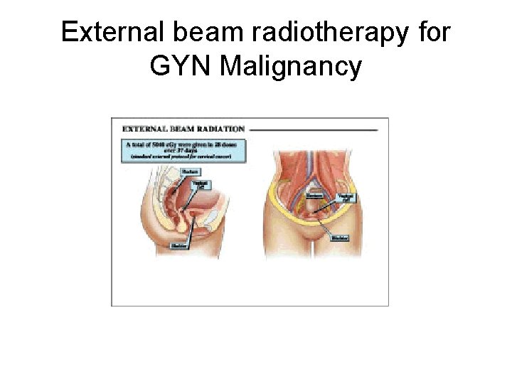 External beam radiotherapy for GYN Malignancy 