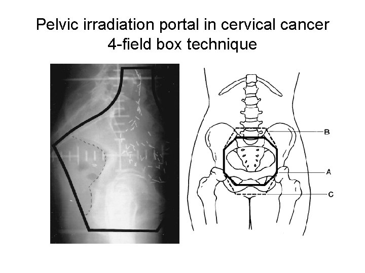 Pelvic irradiation portal in cervical cancer 4 -field box technique 