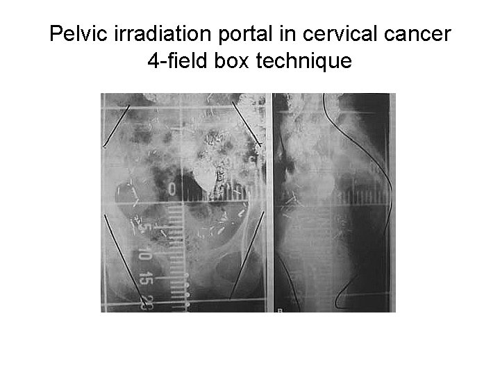 Pelvic irradiation portal in cervical cancer 4 -field box technique 