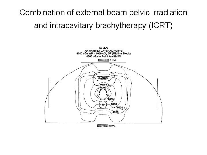 Combination of external beam pelvic irradiation and intracavitary brachytherapy (ICRT) 