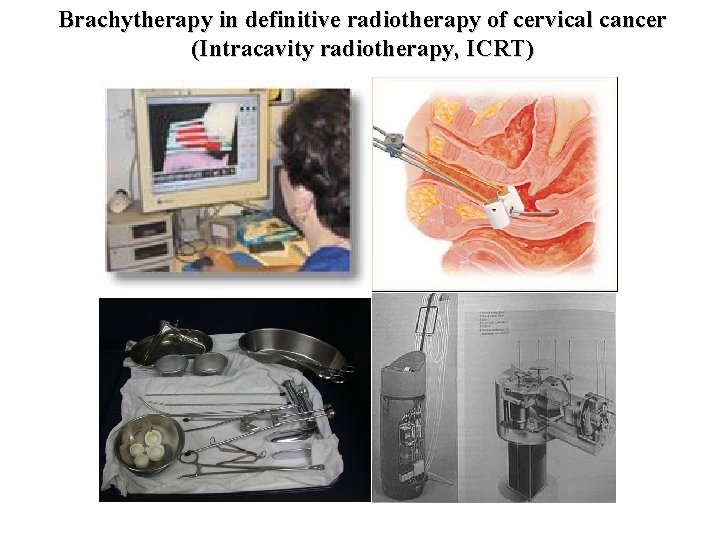 Brachytherapy in definitive radiotherapy of cervical cancer (Intracavity radiotherapy, ICRT) 