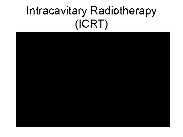 Intracavitary Radiotherapy (ICRT) 