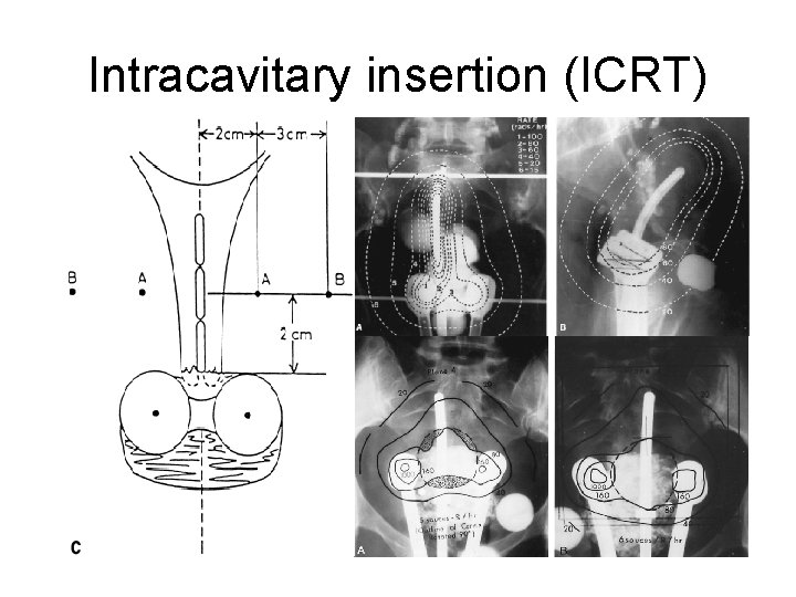 Intracavitary insertion (ICRT) 