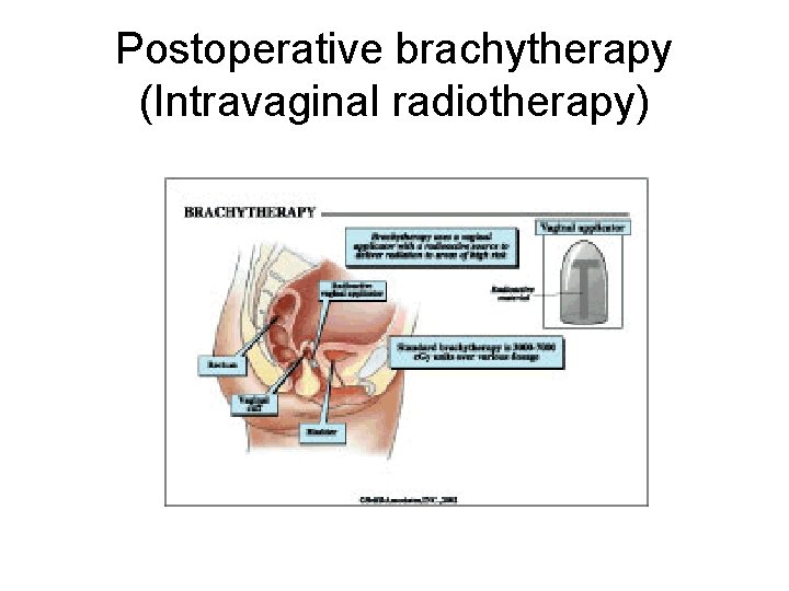 Postoperative brachytherapy (Intravaginal radiotherapy) 