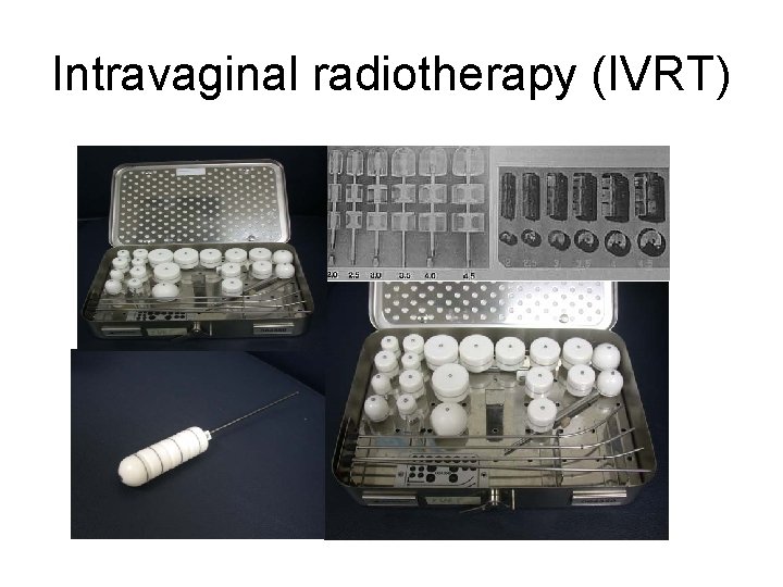 Intravaginal radiotherapy (IVRT) 