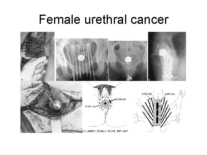 Female urethral cancer 