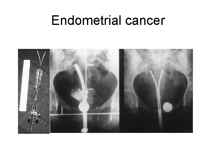 Endometrial cancer 