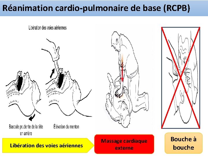 Réanimation cardio-pulmonaire de base (RCPB) Libération des voies aériennes Massage cardiaque externe Bouche à