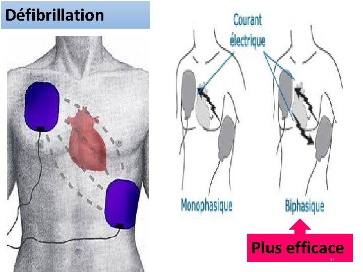 Défibrillation Plus efficace 23 