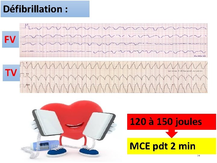 Défibrillation : FV TV 120 à 150 joules MCE pdt 2 min 24 