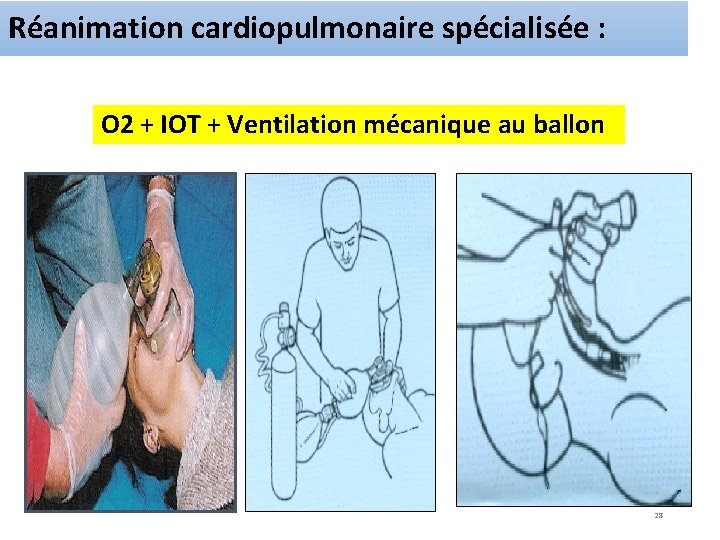 Réanimation cardiopulmonaire spécialisée : O 2 + IOT + Ventilation mécanique au ballon 28