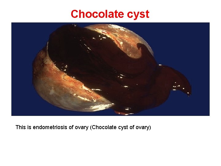 Chocolate cyst This is endometriosis of ovary (Chocolate cyst of ovary) 