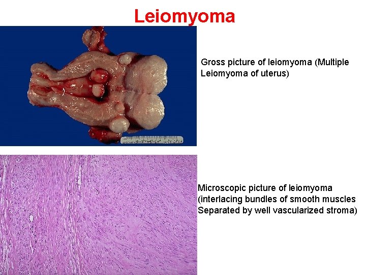 Leiomyoma Gross picture of leiomyoma (Multiple Leiomyoma of uterus) Microscopic picture of leiomyoma (interlacing
