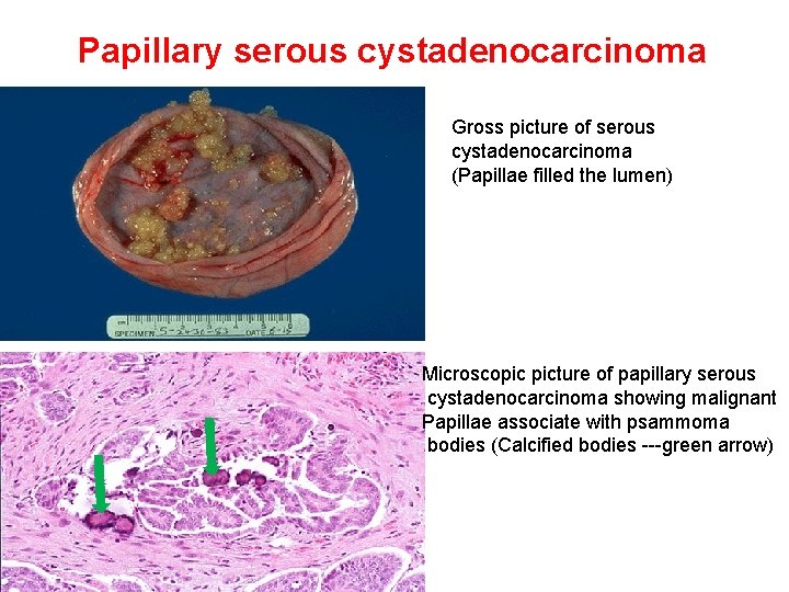 Papillary serous cystadenocarcinoma Gross picture of serous cystadenocarcinoma (Papillae filled the lumen) Microscopic picture