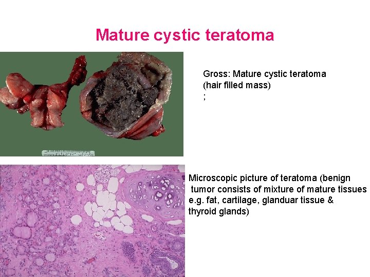 Mature cystic teratoma Gross: Mature cystic teratoma (hair filled mass) ; Microscopic picture of