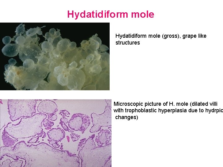 Hydatidiform mole (gross), grape like structures Microscopic picture of H. mole (dilated villi with