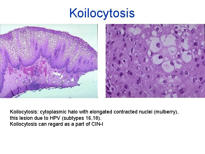 Koilocytosis: cytoplasmic halo with elongated contracted nuclei (mulberry), this lesion due to HPV (subtypes