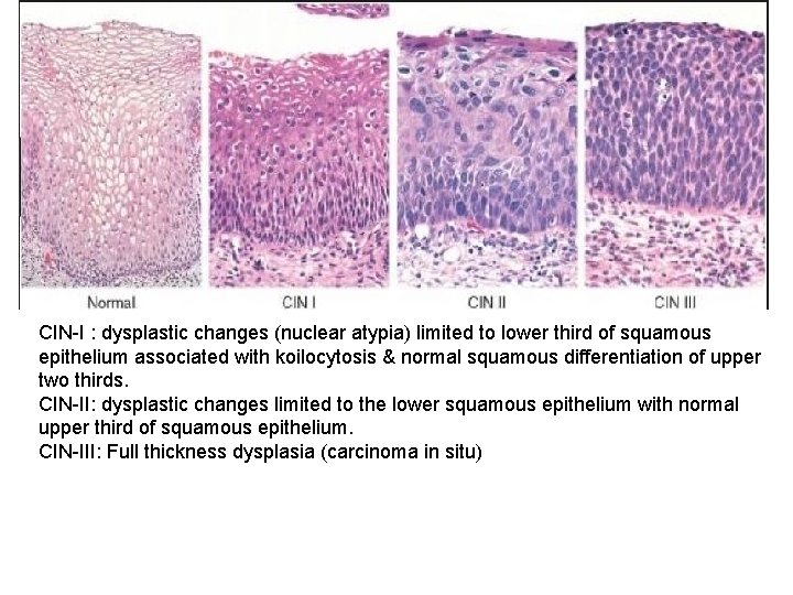 CIN-I : dysplastic changes (nuclear atypia) limited to lower third of squamous epithelium associated