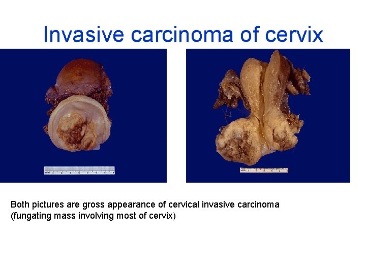 Invasive carcinoma of cervix Both pictures are gross appearance of cervical invasive carcinoma (fungating