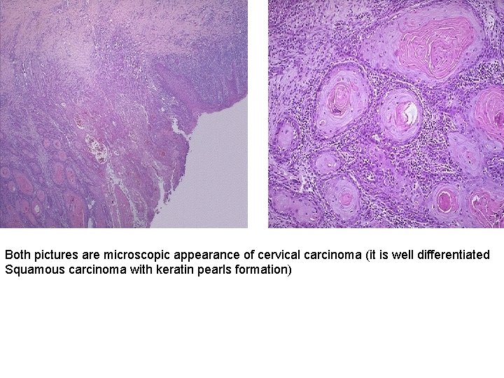 Both pictures are microscopic appearance of cervical carcinoma (it is well differentiated Squamous carcinoma