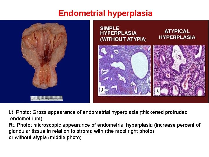 Endometrial hyperplasia Lt. Photo: Gross appearance of endometrial hyperplasia (thickened protruded endometrium). Rt. Photo: