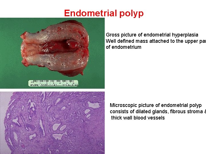 Endometrial polyp Gross picture of endometrial hyperplasia Well defined mass attached to the upper
