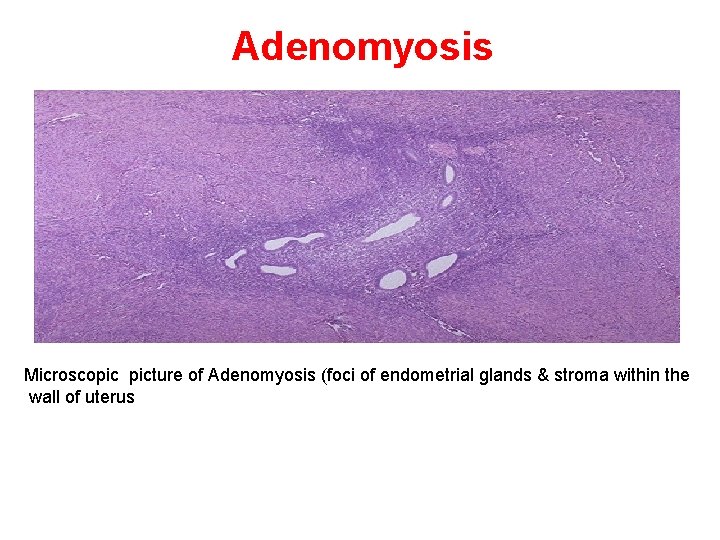 Adenomyosis Microscopic picture of Adenomyosis (foci of endometrial glands & stroma within the wall