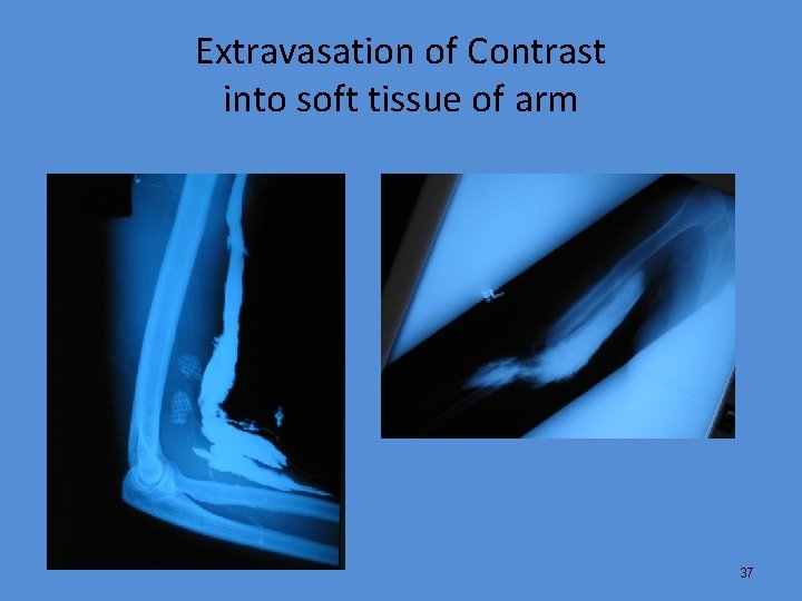 Extravasation of Contrast into soft tissue of arm 37 