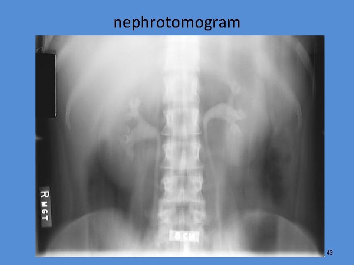 nephrotomogram 49 