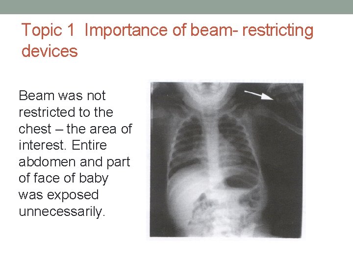 Topic 1 Importance of beam- restricting devices Beam was not restricted to the chest
