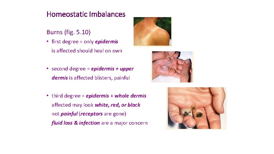 Homeostatic Imbalances Burns (fig. 5. 10) • first degree = only epidermis is affected