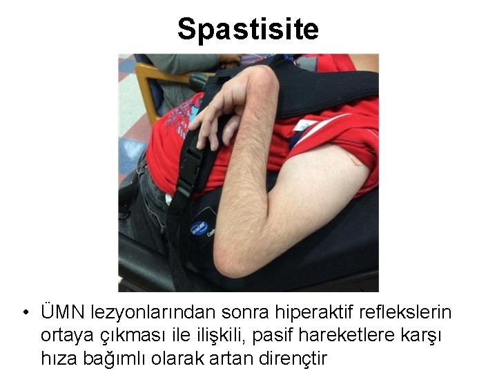 Spastisite • ÜMN lezyonlarından sonra hiperaktif reflekslerin ortaya çıkması ile ilişkili, pasif hareketlere karşı