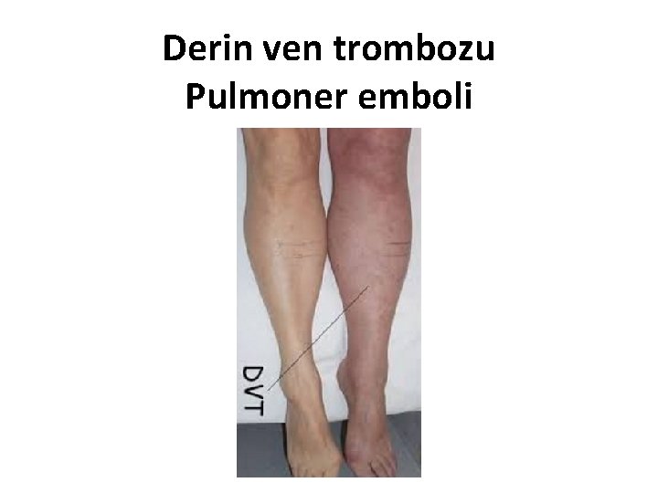 Derin ven trombozu Pulmoner emboli 