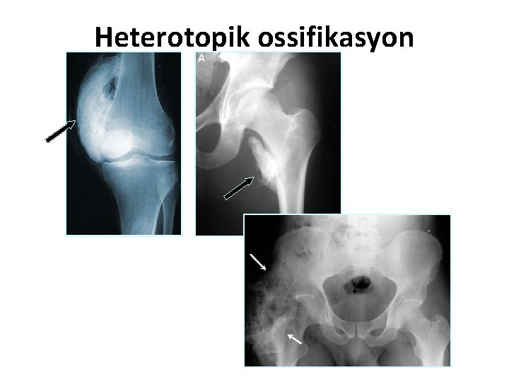 Heterotopik ossifikasyon 