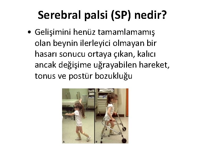 Serebral palsi (SP) nedir? • Gelişimini henüz tamamlamamış olan beynin ilerleyici olmayan bir hasarı