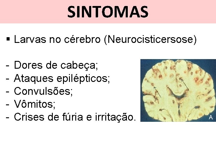 SINTOMAS § Larvas no cérebro (Neurocisticersose) - Dores de cabeça; Ataques epilépticos; Convulsões; Vômitos;