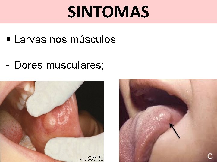 SINTOMAS § Larvas nos músculos - Dores musculares; 