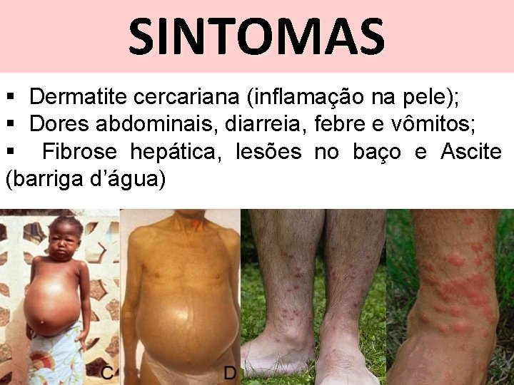 SINTOMAS § Dermatite cercariana (inflamação na pele); § Dores abdominais, diarreia, febre e vômitos;