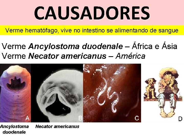 CAUSADORES Verme hematófago, vive no intestino se alimentando de sangue Verme Ancylostoma duodenale –