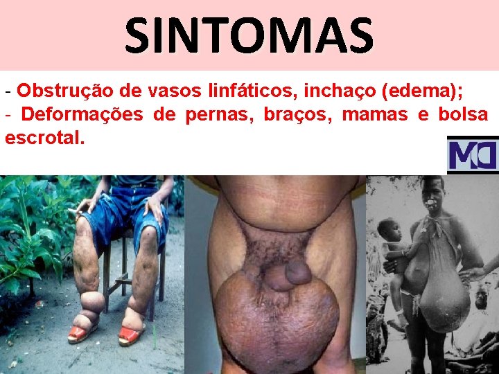 SINTOMAS - Obstrução de vasos linfáticos, inchaço (edema); - Deformações de pernas, braços, mamas