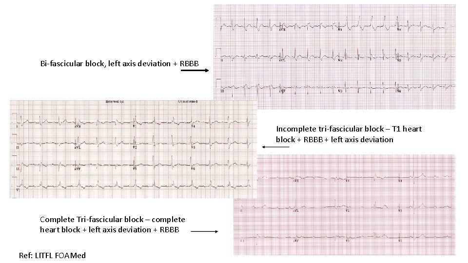 Bi-fascicular block, left axis deviation + RBBB Incomplete tri-fascicular block – T 1 heart