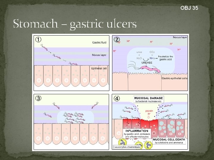 OBJ 35 Stomach – gastric ulcers 