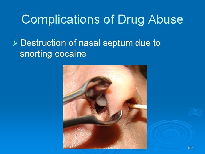 Complications of Drug Abuse Destruction of nasal septum due to snorting cocaine 65 