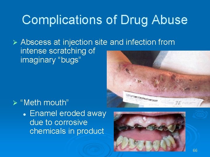 Complications of Drug Abuse Abscess at injection site and infection from intense scratching of