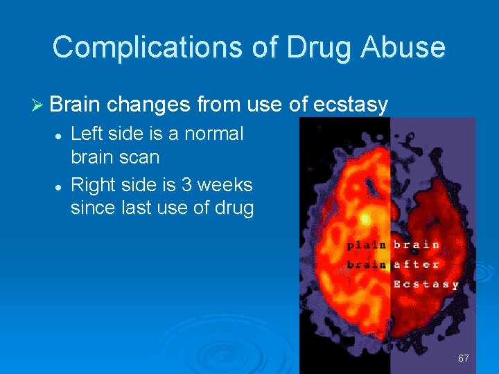 Complications of Drug Abuse Brain changes from use of ecstasy l l Left side