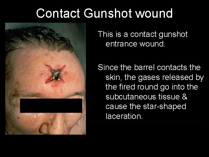 Contact Gunshot wound This is a contact gunshot entrance wound. Since the barrel contacts