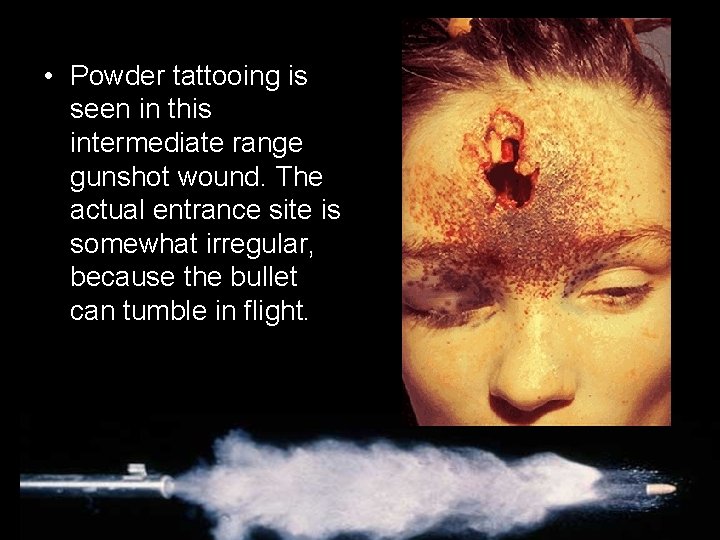  • Powder tattooing is seen in this intermediate range gunshot wound. The actual