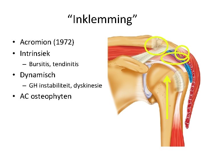 “Inklemming” • Acromion (1972) • Intrinsiek – Bursitis, tendinitis • Dynamisch – GH instabiliteit,