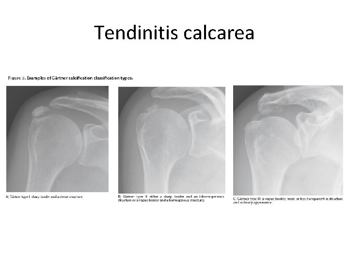 Tendinitis calcarea 