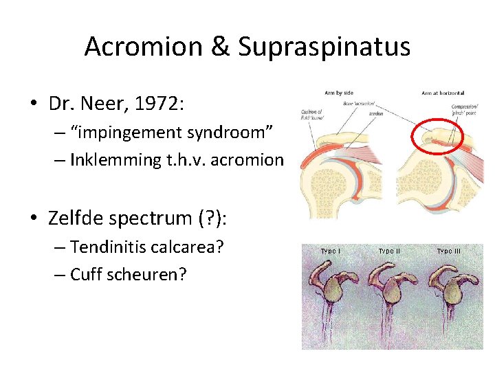 Acromion & Supraspinatus • Dr. Neer, 1972: – “impingement syndroom” – Inklemming t. h.